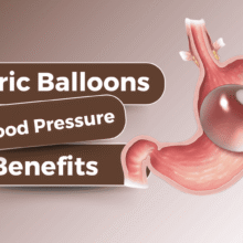Image of Animated Illustration of a Gastric Ballon